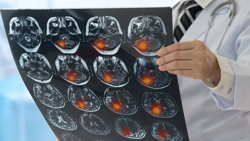 Cara Sederhana Mencegah Kanker Otak