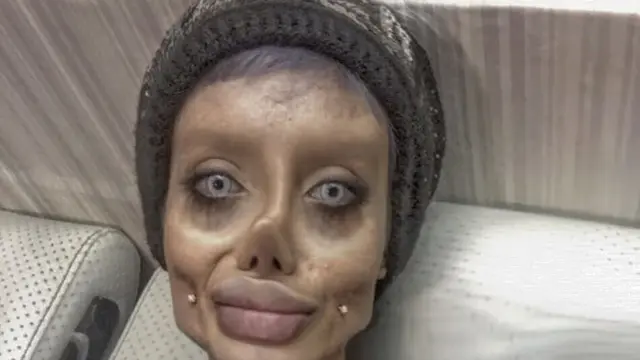 Gadis Iran Tempuh 50 Operasi Plastik Agar Mirip Angelina Jolie