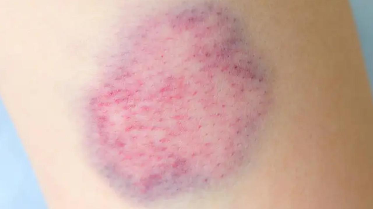 Luka memar (Foto: Dinas Kesehatan Provinsi Kalimantan Barat)