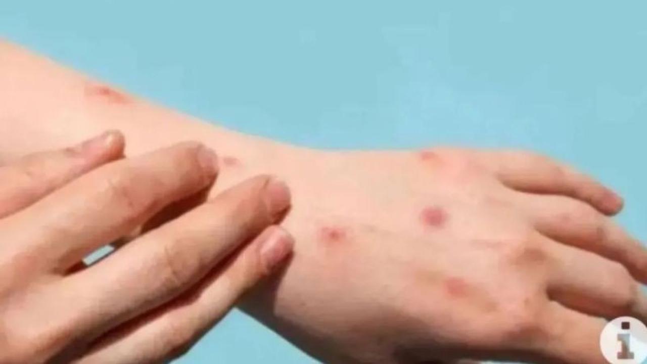 Tragis, Santri di Meranti Meninggal Diduga Terinfeksi Cacar Monyet: Waspadai Gejala Awal!
