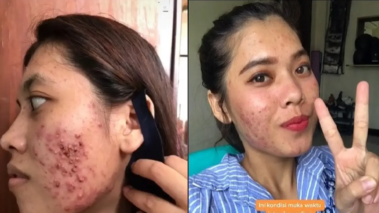 Gagal diterima kerja karena jerawat