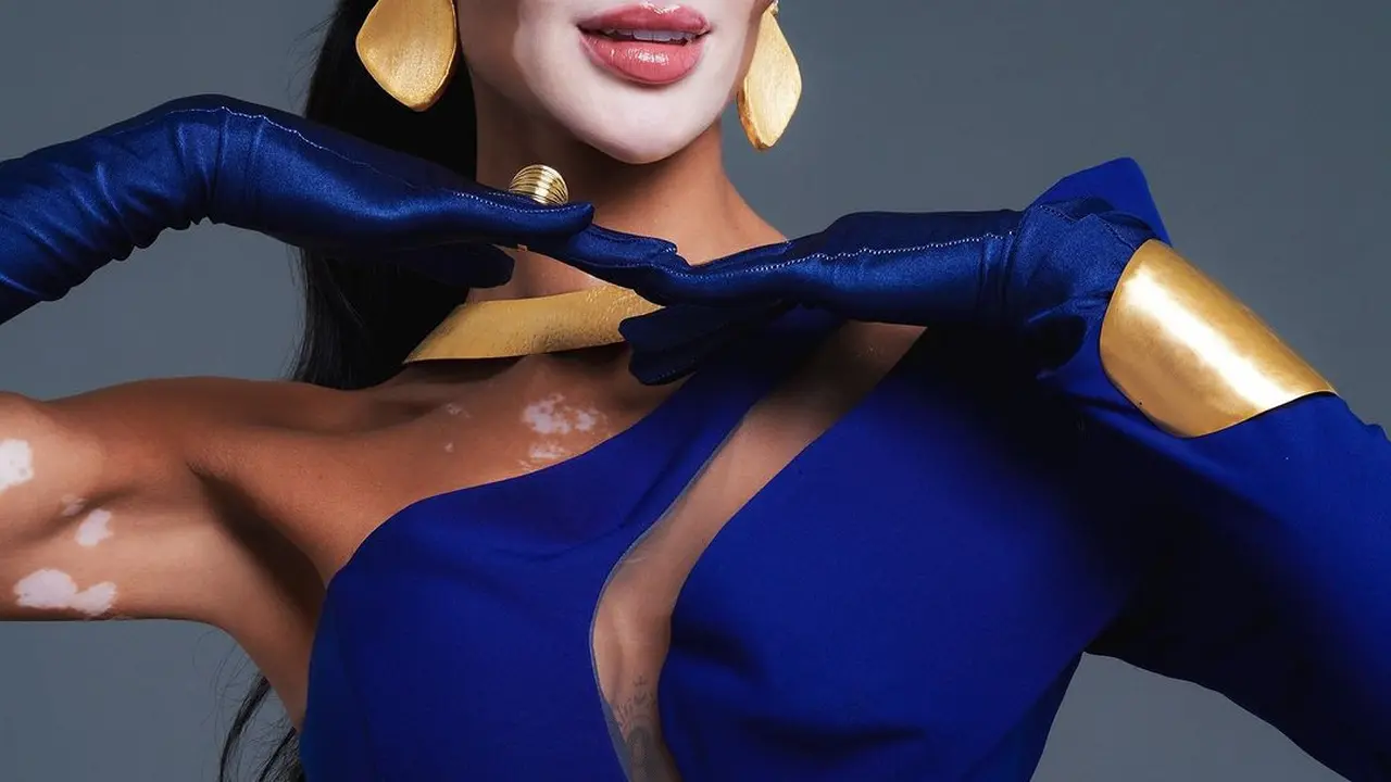 Buktikan Vitiligo Bukan Penghalang, Begini Sosok Logina Salah Miss ...