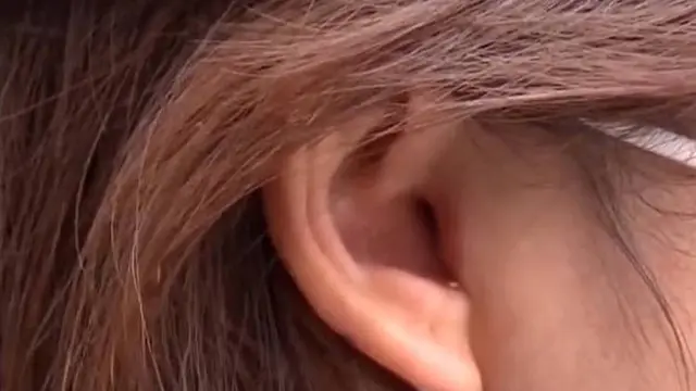 wanita kehilangan tulang rawan telinganya usai operasi hidung