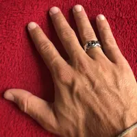 Tak ingin membuang logam yang pernah menolongnya dari patah tulang, pria ini mengubahnya jadi cincin. (Via: boredpanda.com)