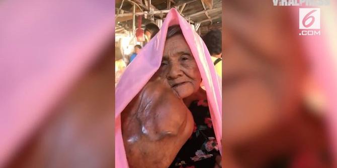 VIDEO: Tumor Sebesar Kepala di Pipi Nenek 79 Tahun