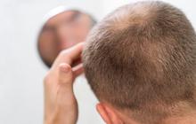 Begini Cara Merawat Rambut yang Benar Agar Terhindar dari Kebotakan Menurut Dokter