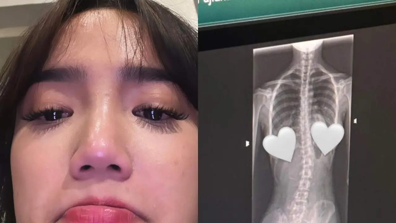 Fuji Menangis usai Tahu Idap Skoliosis, Kenali Penyebab dan Gejalanya