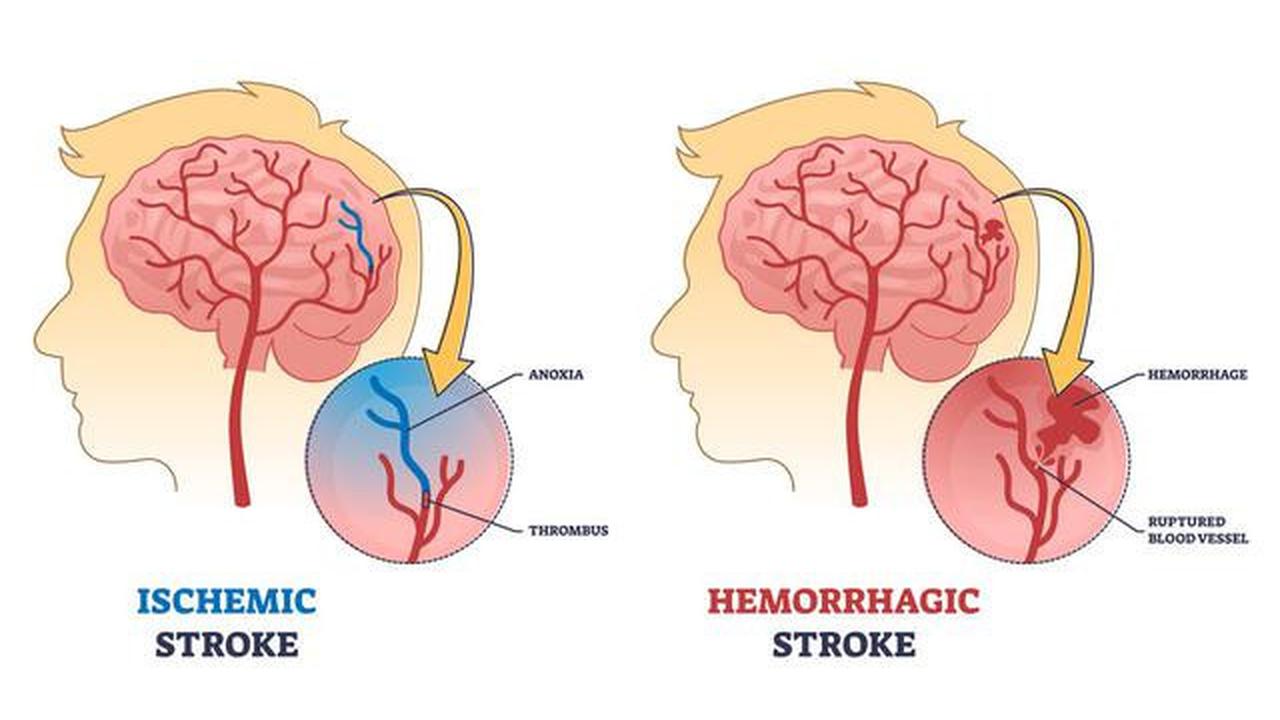 Kenali Risiko Stroke Sejak Dini, Begini Gejala dan Cara Penanganannya