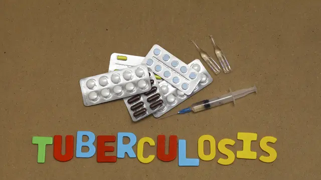 Ilustrasi TB - TBC (iStockphoto)