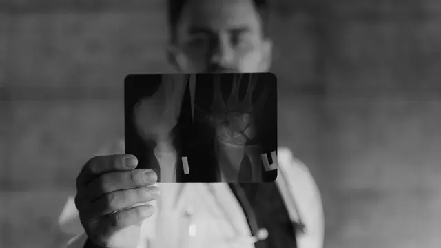 Osteogenesis Imperfecta (OI) Tulang Mudah Patah Sejak Kandungan