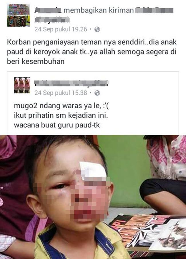 Anak PAUD korban penganiayaan temannya menderita luka cukup serius di wajah | Photo: Copyright facebook.com/Komunitas Peduli Malang (ASLI Malang)