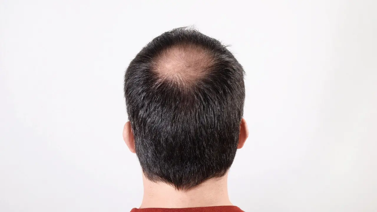 Apa Itu Alopesia dan Bagaimana Cara Menanganinya?