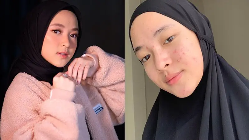 Unggah Foto Berjerawat, Ini 6 Potret Nissa Sabyan Tanpa Makeup