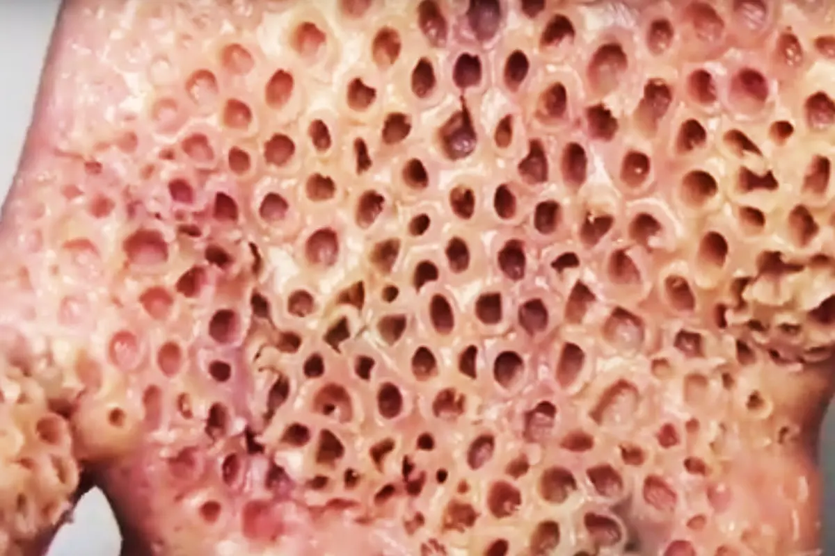 [Bintang] Jika Foto Ini Membuatmu Takut, Mungkin Kamu Terkena Trypophobia