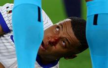FOTO: Momen Hidung Kylian Mbappe Patah dan Berdarah Saat Laga Prancis Vs Austria