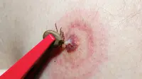 Tahukah kamu Lyme Disease alias penyakit Lyme? Kalau belum, jangan lewatkan artikel ini.