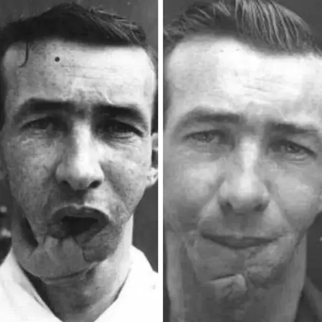 Foto sebelum dan sesudah Prajurit Arthur Mears melakukan operasi plastik karena wajahnya terluka akibat perang. Credits: Media Drum World via The Sun
