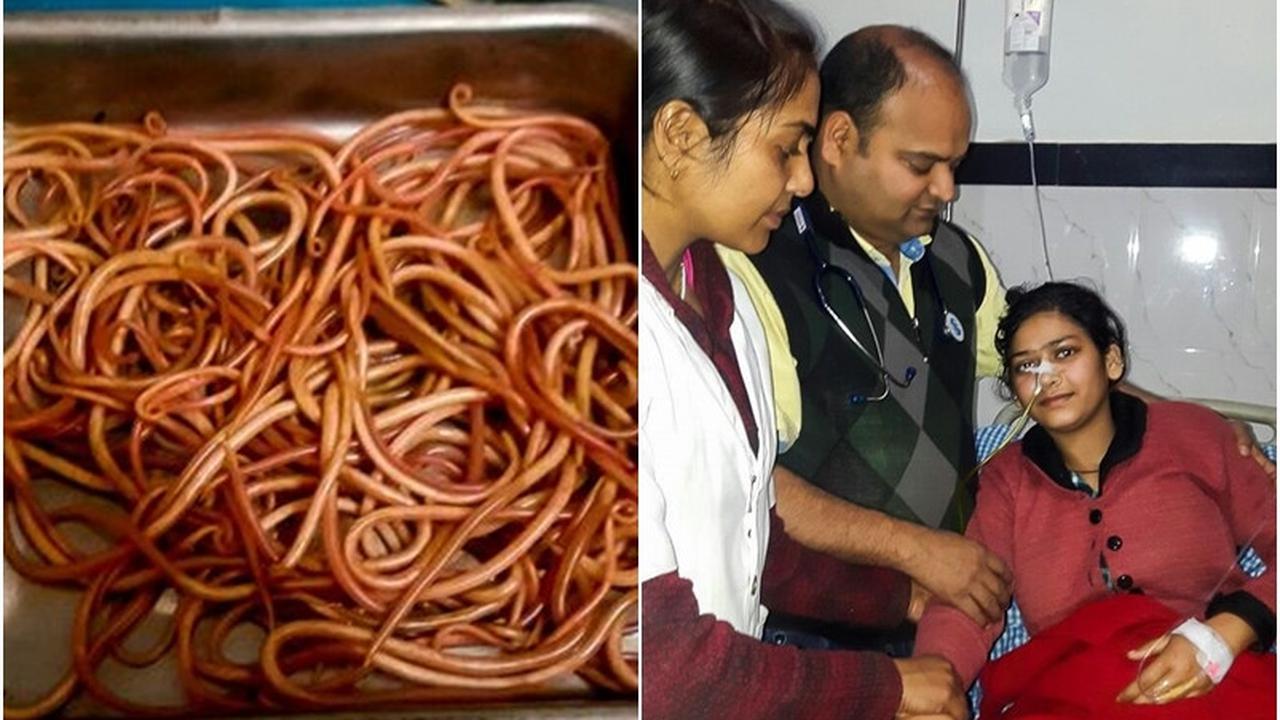 Sakit Perut, 150 Cacing Dikeluarkan dari Perut Wanita Ini