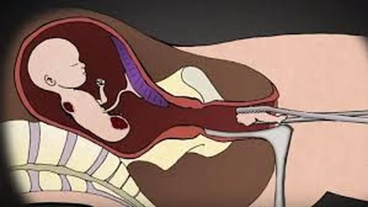 Ilustrasi Aborsi di Banyuwangi (Istimewa)