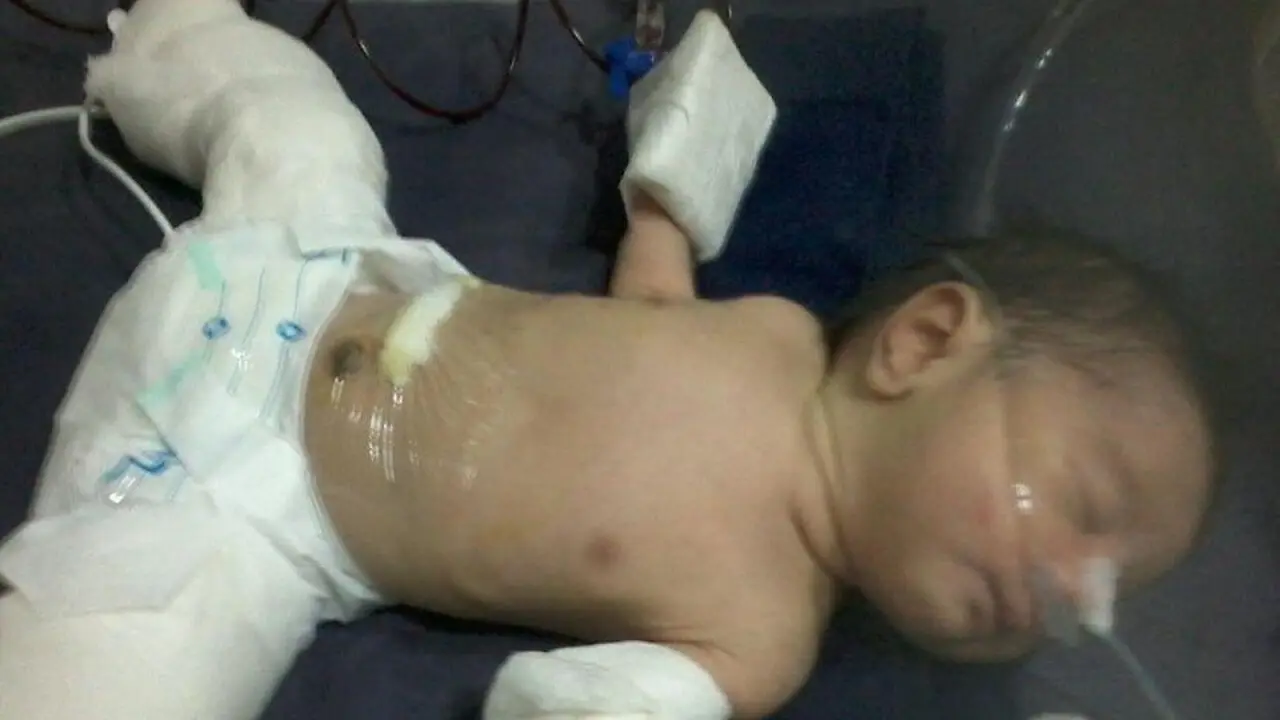 Tak Lazim, Bayi di Kandungan Saudara Kembarnya Saat di Lahirkan