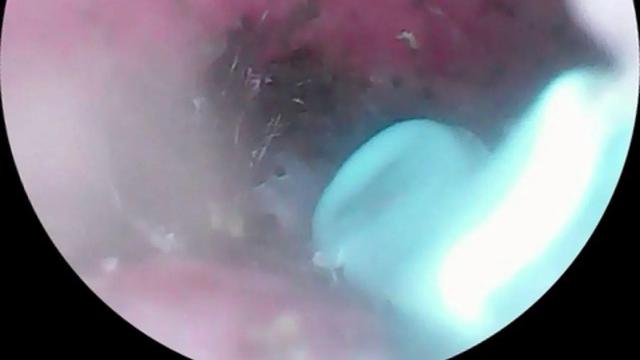 Bikin Merinding, Telinga Wanita Ini Gatal Karena Jadi Sarang Laba-Laba