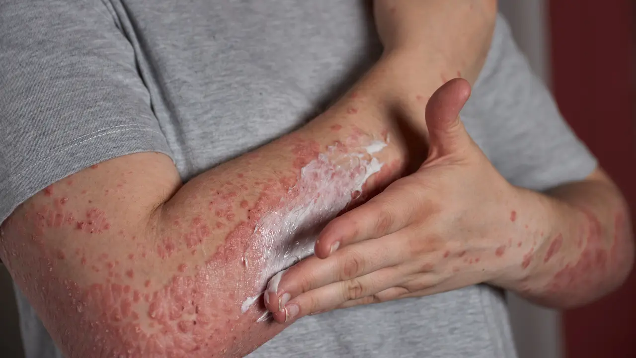Lupus Belum Bisa Disembuhkan Total, Ini Perawatan yang Dapat Dilakukan Dokter