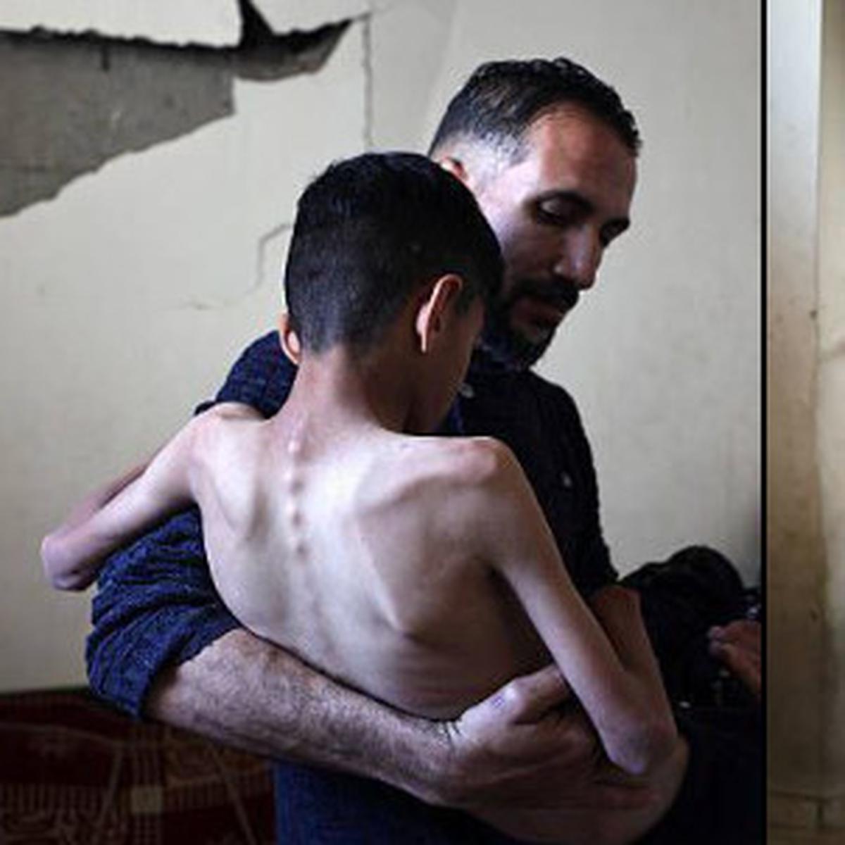 Anak di Gaza Alami Kelaparan