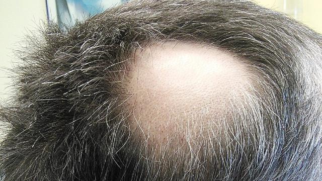 Apa itu alopecia