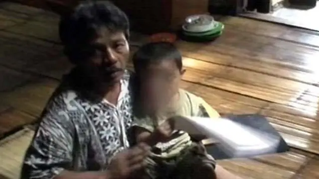 Bocah Penderita Tumor Hidung Kian Memprihatinkan