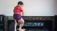 Kaki Bocah Ini Terus Bengkak dan Berdarah Bila Berjalan