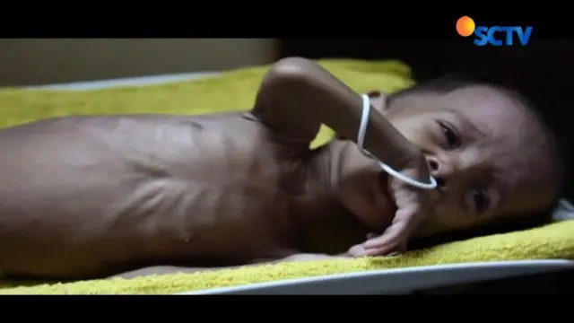 Sebanyak 1.900 orang meninggal, 1 juta anak dilanda malnutrisi akut akibat wabah kolera di Yaman.