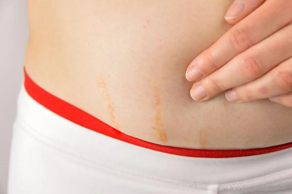 stretch mark