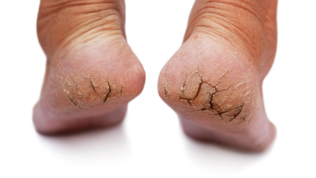 Cara Merawat Kaki Pecah-pecah