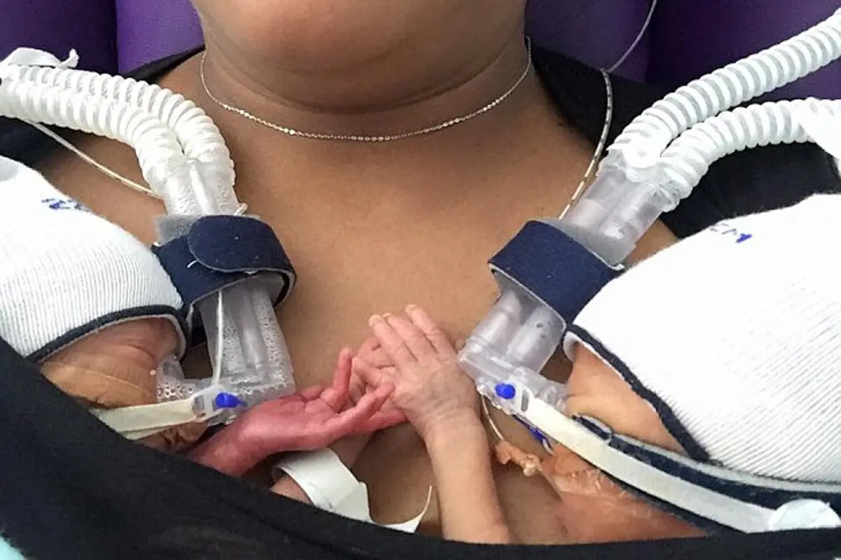 Lahir Prematur, Bayi Kembar Ini Selalu Berpegangan Tangan