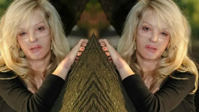 [Bintang] Disiram Air Keras oleh Kekasihnya, Wanita Ini Mencoba Bangkit