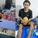 Kisah Pilu Winarso Berjuang Melawan Infeksi Tulang