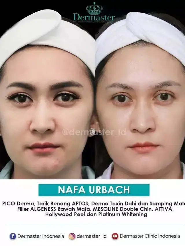 Potret Nafa Urbach sebelum dan sesudah tanam benang (Sumber: Instagram/dermaster_id)