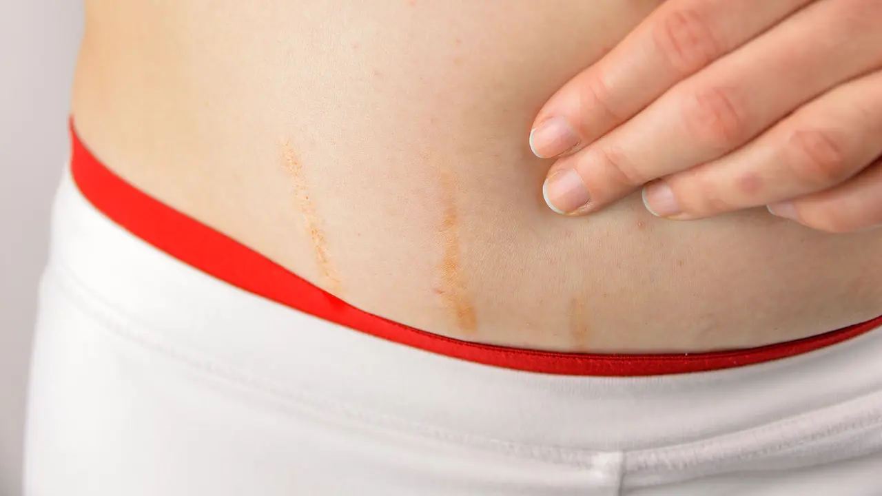 Stretch marks (iStock)