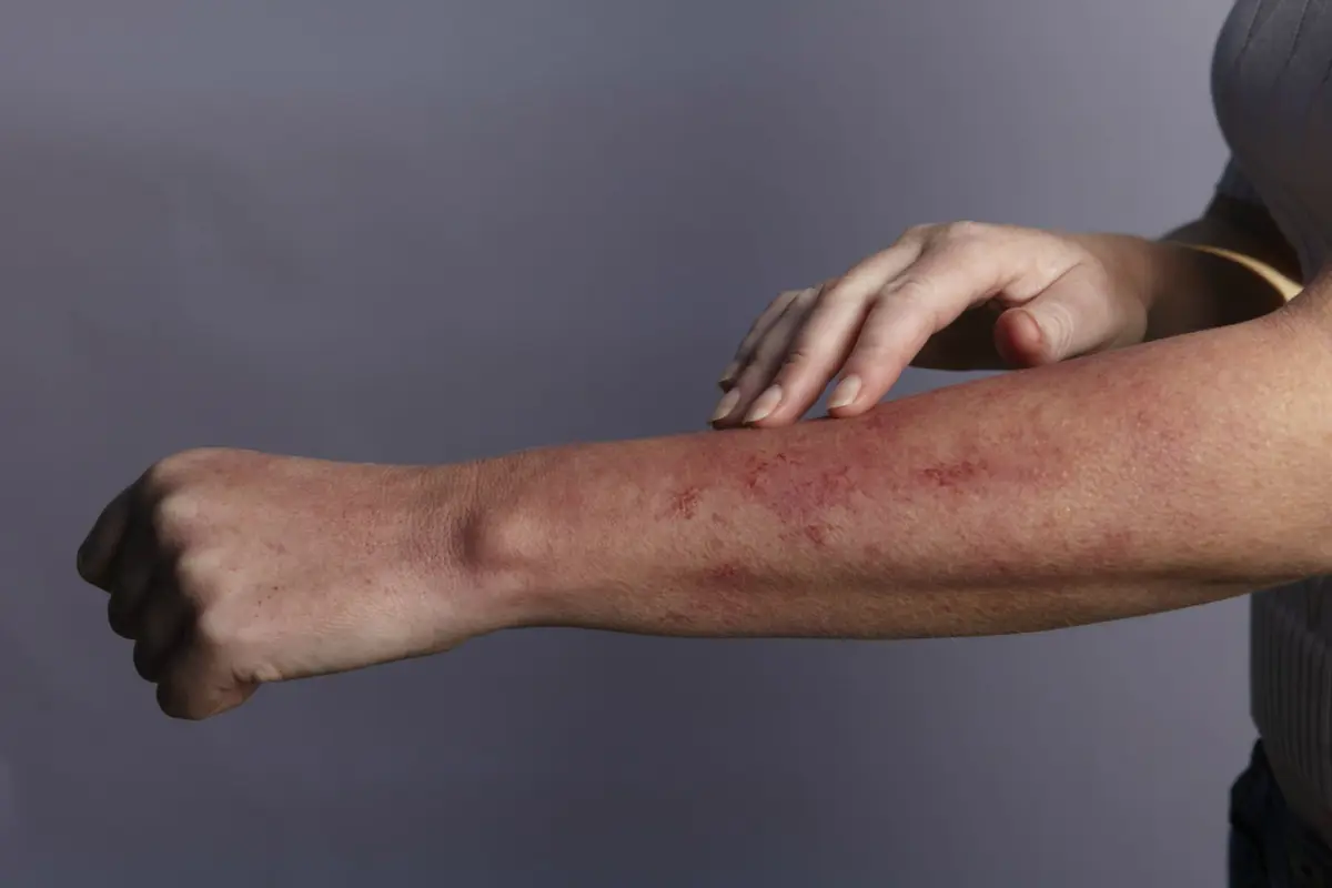 Ini Gejala Awal Penyakit Lupus yang Harus Diwaspadai