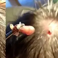 Mengerikan! Seekor belatung ditemukan dalam kepala lelaki ini. Hal tersebut membuktikan parasit itu bisa bersarang di badan kita. Hiii ....