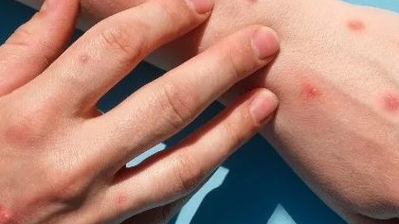 Cara Mengobati Cacar Monyet pada Anak, Kenali Gejalanya
