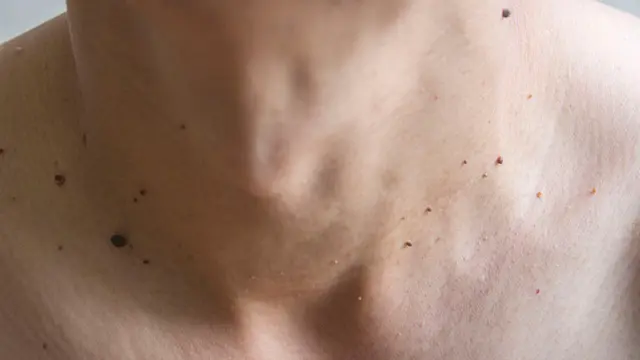 Memiliki Banyak Tahi Lalat, Haruskah Khawatir?