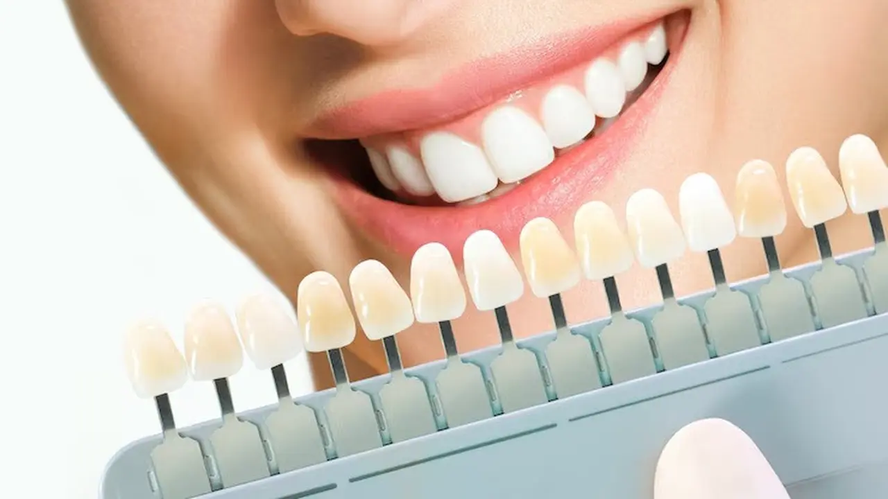 Veneer gigi