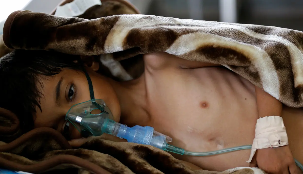 Seorang anak yang kekurangan gizi mendapat perawatan di sebuah rumah sakit di Sanaa, Yaman pada 27 September 2016. Perang sipil selama 18 bulan terakhir telah membuat jutaan orang kelaparan. (REUTERS/Khaled Abdullah)