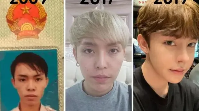 Viral Transformasi Pria Ini Usai Operasi Plastik Bikin Takjub, Bak Idol K-Pop