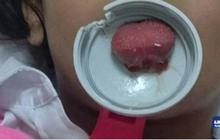 Miris! Lidah anak Saudi nyangkut di tutup botol