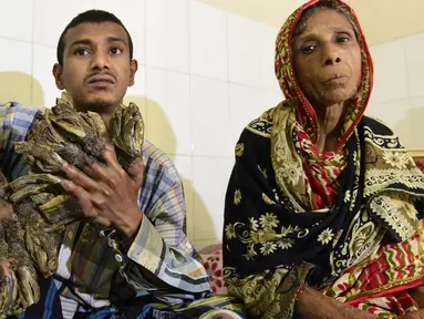 Abul Bajandar (26) mengalami kutil berlebihan yang membuatnya tampak seperti manusia akar, di Dhaka Medical College dan Rumah Sakit, Bangladesh, Minggu (31/1). Bajandar mengaku penyakitnya pertama kali muncul pada 10 tahun lalu. (AFP Photo/Munir uz ZAMAN)