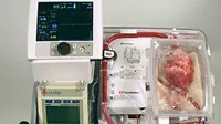 sebuah terobosan baru yang dilakukan ahli bedah Australia mengklaim bisa menyelamatkan pasien dengan transplantasi dari jantung mati