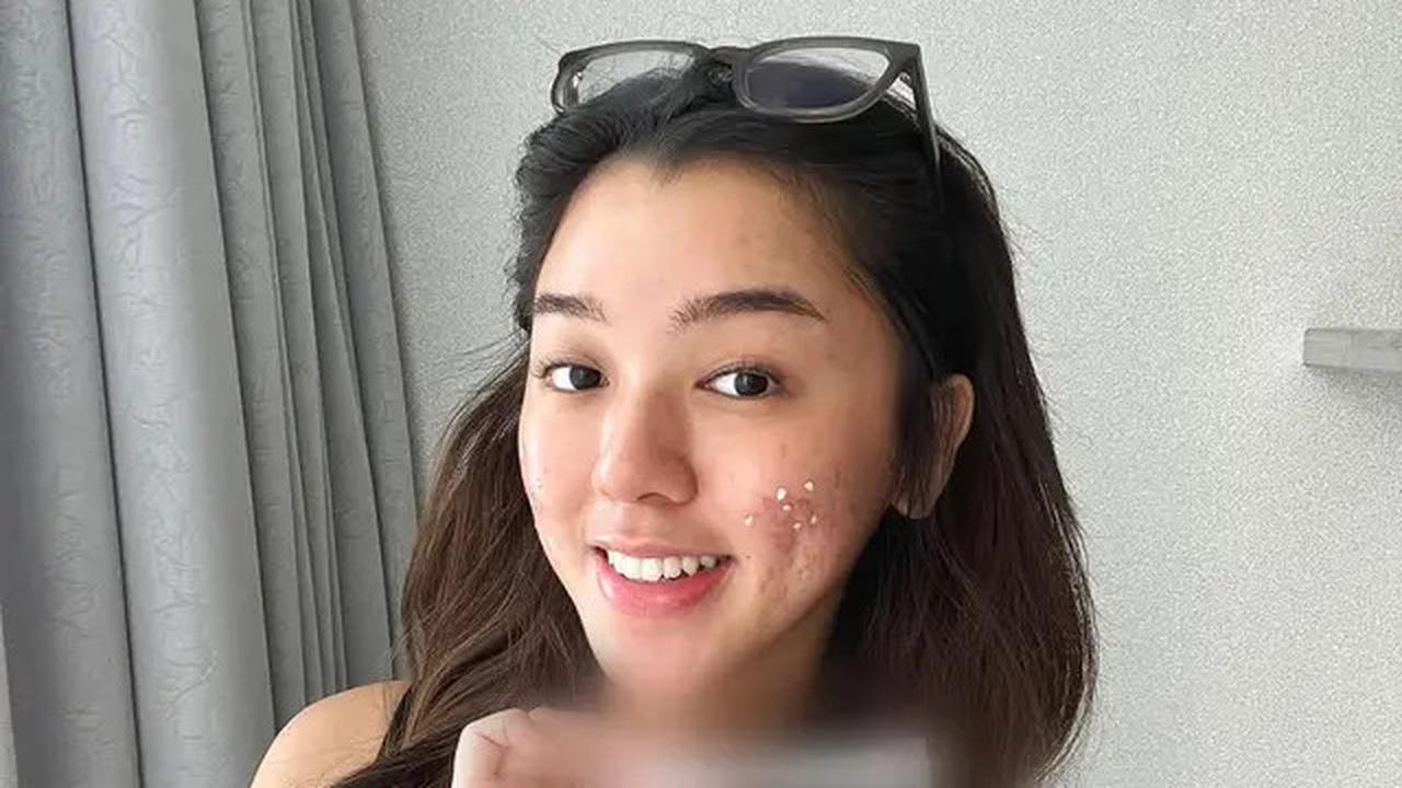 6 Potret Wajah Gabriella Ekaputri Berjerawat, Tetap Percaya Diri Tampil Natural