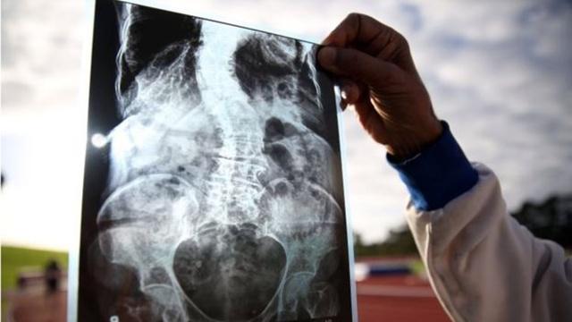 Nenek Kaur menunjukkan hasil rontgen tulang belakangnya | Photo: Copyright bbc.com